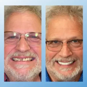 𝗙𝘂𝗻𝗰𝘁𝗶𝗼𝗻𝗮𝗹 𝗧𝗵𝗶𝗰𝗸𝗲𝗻𝗲𝗱 𝗗𝗲𝗻𝘁𝘂𝗿𝗲𝘀 - Image 12