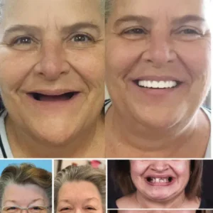🦷Advanced Customized Full Denture Set🦷 - Image 7