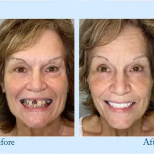 🦷Advanced Customized Full Denture Set🦷 (⏰Limited time discount last 30 minutes⏰)🍁🍁 - Image 10