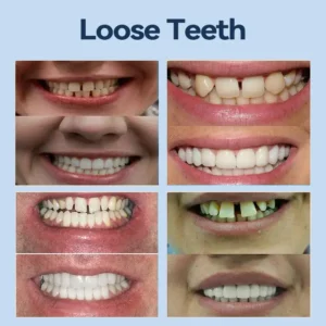 👧🏻🔆- 𝐏𝐫𝐞𝐦𝐢𝐮𝐦 𝐃𝐞𝐧𝐭𝐮𝐫𝐞- (✨Suitable for all mouth shapes, custom-made dentures for a perfect fit✨） - Image 6