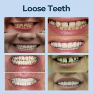 👧🏻🔆- 𝐏𝐫𝐞𝐦𝐢𝐮𝐦 𝐃𝐞𝐧𝐭𝐮𝐫𝐞- (✨Suitable for all mouth shapes, custom-made dentures for a perfect fit✨） - Image 6