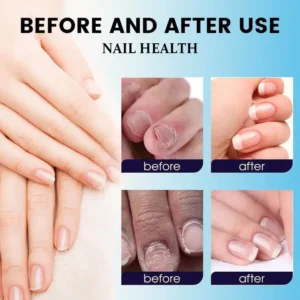 Nail Fungus Laser Treatment Device - Image 12