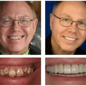 🦷 Custom-Fit Functional Dentures 😁 Smile with Confidence - Image 3