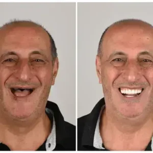🦷 Custom-Fit Functional Dentures 😁 Smile with Confidence - Image 2