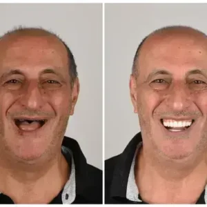 Alternative view of 🦷 Custom-Fit Functional Dentures 😁 Smile with Confidence