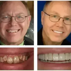 🦷 Custom-Fit Functional Dentures 😁 Smile with Confidence - Image 3
