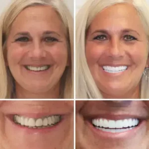 🦷Advanced Customized Full Denture Set - Image 5