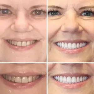 🦷Advanced Customized Full Denture Set - Image 6