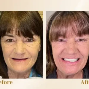 –🦷Advanced Customized Full Denture Set🦷 (⏰Limited time discount last 30 minutes⏰)💎💎 - Image 10