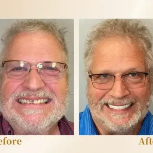 –🦷Advanced Customized Full Denture Set🦷 (⏰Limited time discount last 30 minutes⏰)💎💎 - Image 11