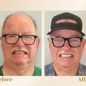 –🦷Advanced Customized Full Denture Set🦷 (⏰Limited time discount last 30 minutes⏰)💎💎 - Image 5