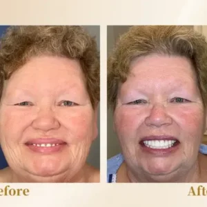 –🦷Advanced Customized Full Denture Set🦷 (⏰Limited time discount last 30 minutes⏰)💎💎 - Image 7
