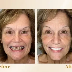 🦷Advanced Customized Full Denture Set🦷 (⏰Limited time discount last 30 minutes⏰)🚁🚁 - Image 6