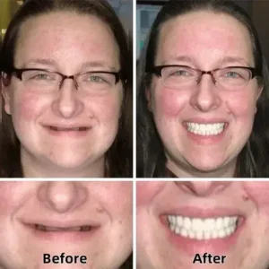 Advanced Custom-Fit Functional Dentures - Image 4