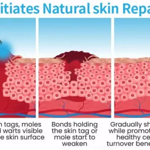 Non-Invasive Mole and Wart Removal Laser Pen - Image 8