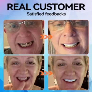 Silicone Reline Denture Set - Image 3