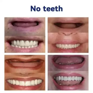 Advanced Customized Full Denture Set - Image 8