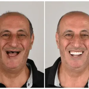 Custom-Fit Functional Dentures - Image 7