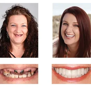 🦷 Custom-Fit Functional Dentures 😁 Smile with Confidence - Image 6