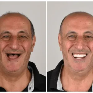 🦷 Custom-Fit Functional Dentures 😁 Smile with Confidence - Image 7