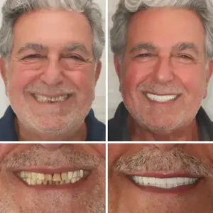 Custom-Fit Functional Dentures - Image 10