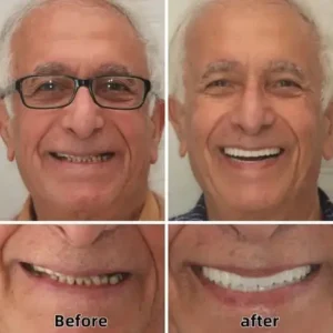 Custom Functional Denture Kits - Image 4