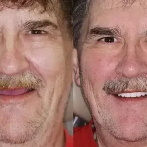 SMILE Premium Denture - Image 10