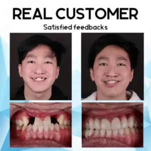 Silicone Reline Denture Set - Image 5
