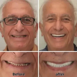 Advanced Custom-Fit Functional Dentures - Image 5