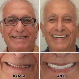 Advanced Custom-Fit Functional Dentures - Image 7