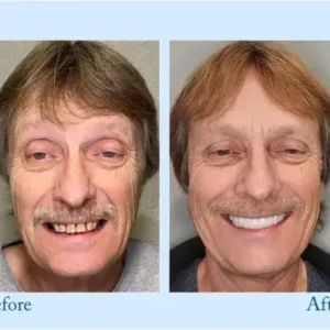 Full Dentures - Image 9