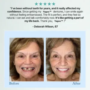 🦷Advanced Customized Full Denture Set🦷 (🔥10,000+ Sold In Last 30 Day) - Image 12