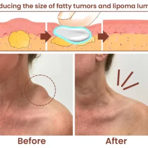 Lipoma Removal Herbal Cream - Image 6