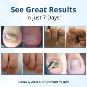 Fungal Nail Patches - Image 2
