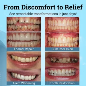 Non-Surgical Gum "Suture" Gel - Image 6