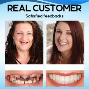 SnapOn Silicone Veneers - Image 5