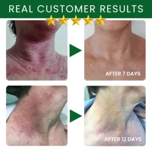 Tea Tree Oil Skin Treatment Cream - Image 7