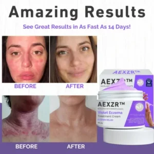 Violet Eczema Treatment Cream - Image 5