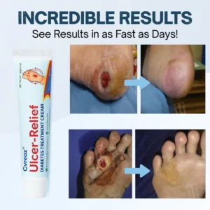 Ulcer-Relief Diabetes Treatment Cream - Image 3