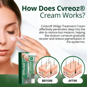 Vitiligo Treatment Cream - Image 2