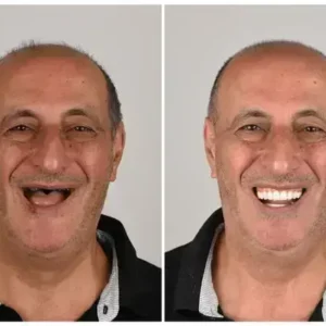 Alternative view of 🦷 Custom-Fit Functional Dentures 😁 Smile with Confidence