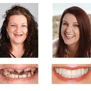 🦷 Custom-Fit Functional Dentures 😁 Smile with Confidence - Image 5