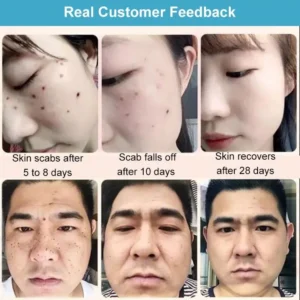 Concentrated potent skin tag removal cream - Image 4
