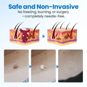 Wart Removal Cream - Image 6
