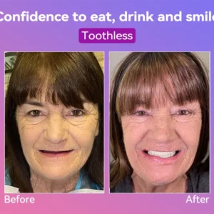 Latest Premium Comfort Dentures - Image 6