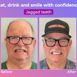 Latest Premium Comfort Dentures - Image 7