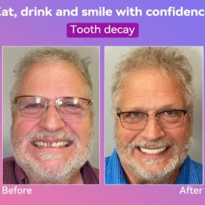 Latest Premium Comfort Dentures - Image 4
