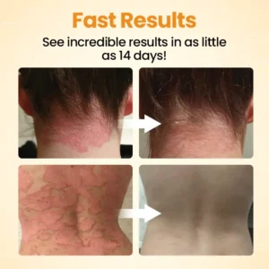 [Official Authorized Store] BeeLieves Psoriasis Skin Care - Image 5