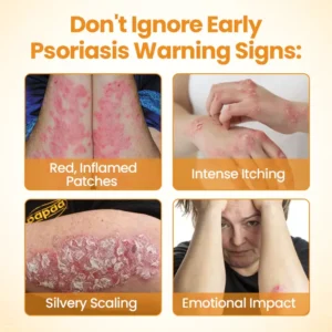 [Official Authorized Store] BeeLieves Psoriasis Skin Care - Image 6