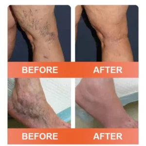 Vein Ease Microneedle Care Patch - Image 4